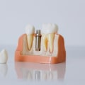 Navigating Pain With Precision: The Role Of Dental Implants In London's Pain Management Landscape
